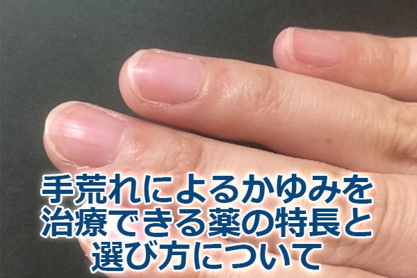 手荒れによるかゆみを治療できる薬の特長と選び方について
